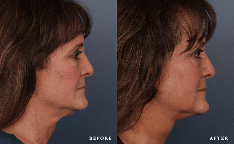 Faces First skin tightening result — Denver, CO