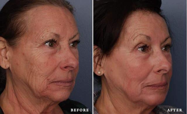 Laser Skin Resurfacing result at Faces First in Denver, CO