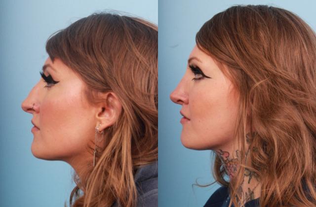 Functional Rhinoplasty result at Faces First in Denver, CO