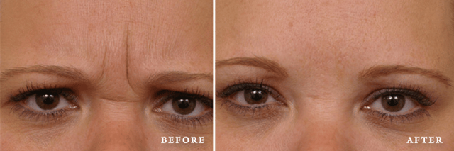 Botox result at Faces First in Denver, CO