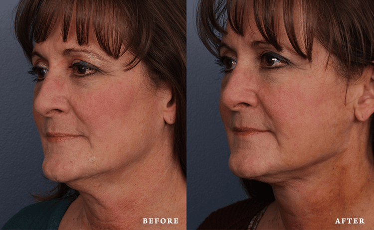 Faces First skin tightening result — Denver, CO