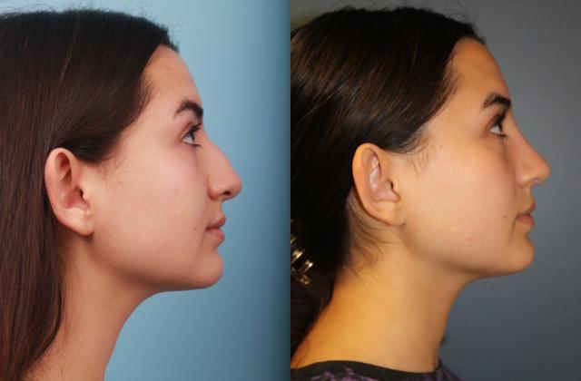 Functional Rhinoplasty result at Faces First in Denver, CO