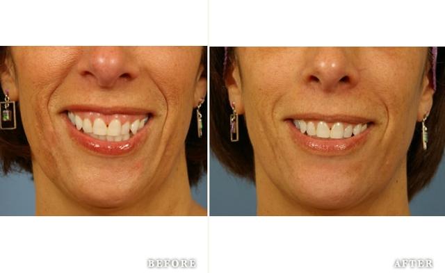 Botox result at Faces First in Denver, CO