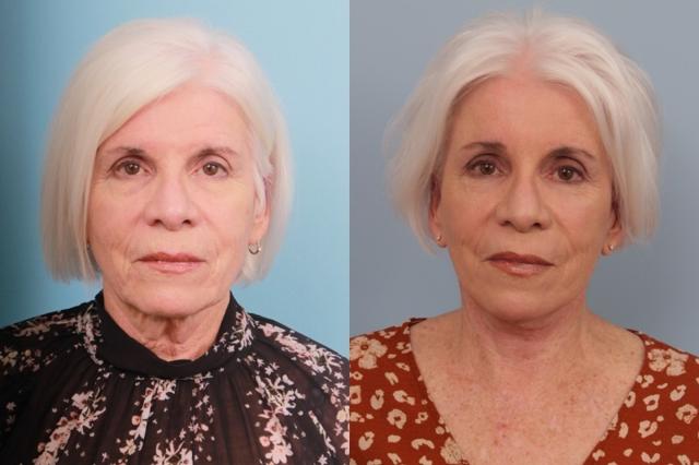 Facelift result at Faces First in Denver, CO