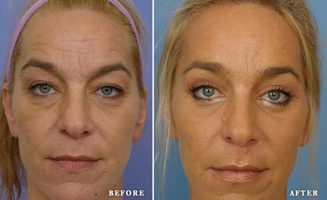Fat Transfer result at Faces First in Denver, CO