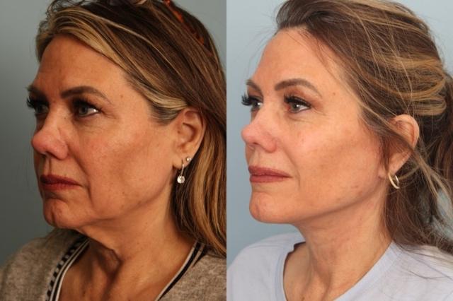 Neck Lift result at Faces First in Denver, CO