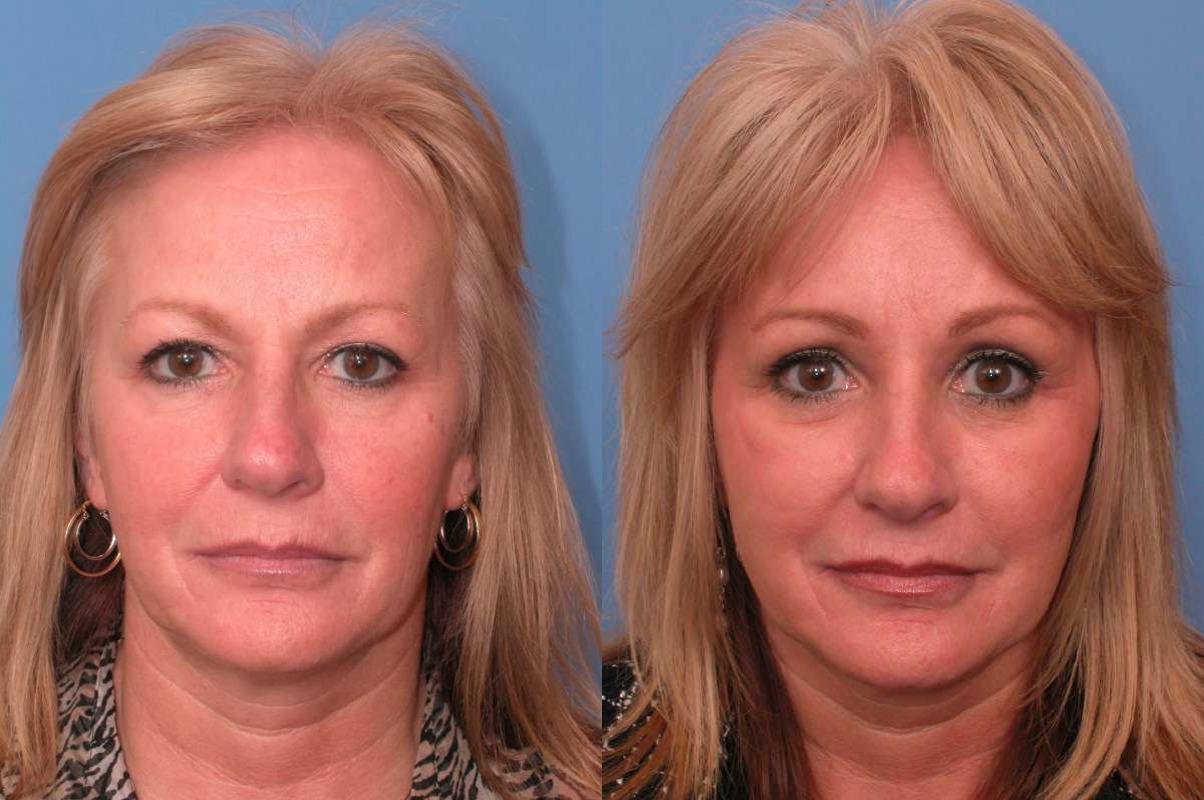 Faces First brow lift result — Denver, CO