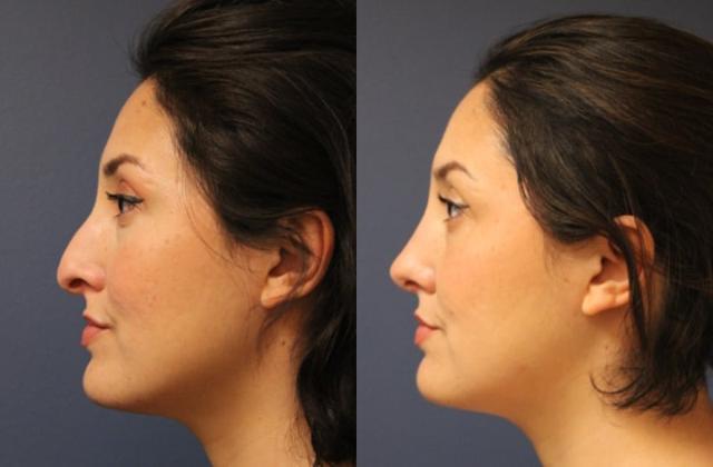 Functional Rhinoplasty result at Faces First in Denver, CO