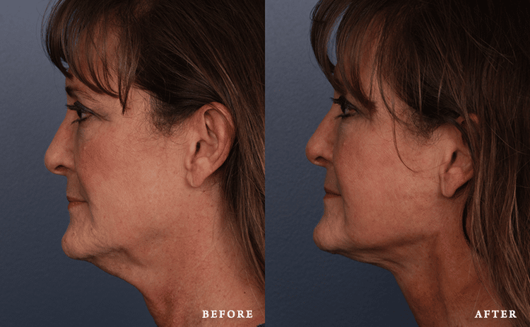 Faces First skin tightening result — Denver, CO