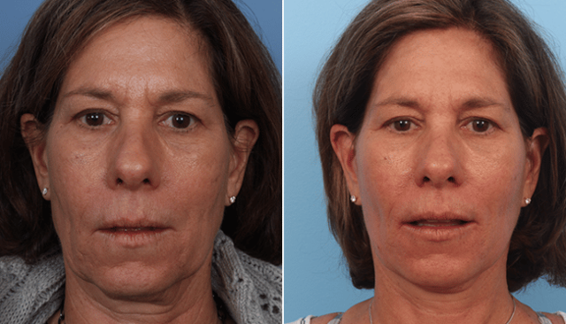 Fat Transfer result at Faces First in Denver, CO