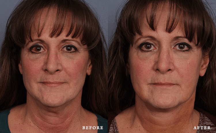 Faces First skin tightening result — Denver, CO