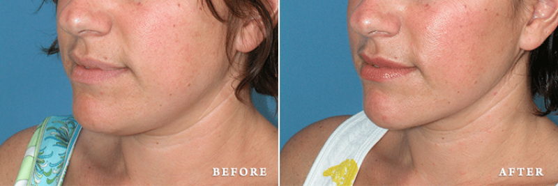 Faces First liposuction result — Denver, CO