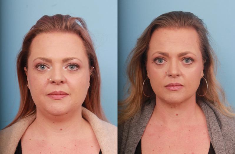 Faces First liposuction result — Denver, CO