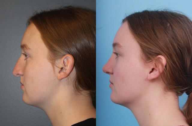 Functional Rhinoplasty result at Faces First in Denver, CO