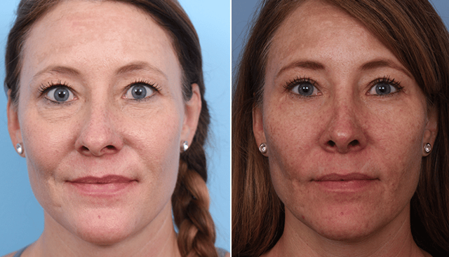 Fat Transfer result at Faces First in Denver, CO