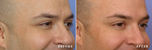 Botox result at Faces First in Denver, CO