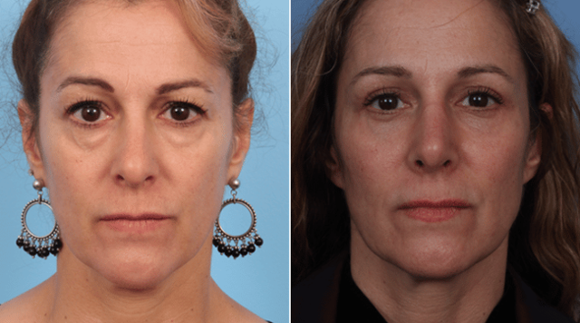 Fat Transfer result at Faces First in Denver, CO