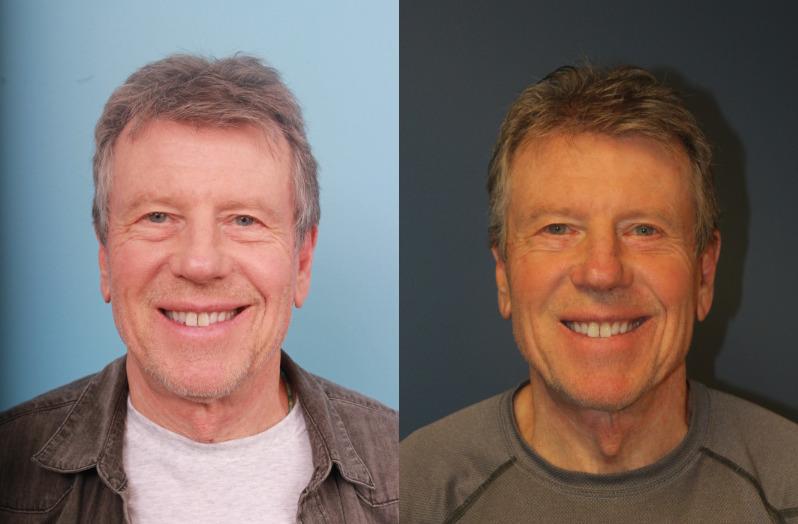 Faces First blepharoplasty result — Denver, CO