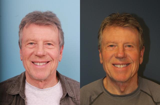 Blepharoplasty result at Faces First in Denver, CO