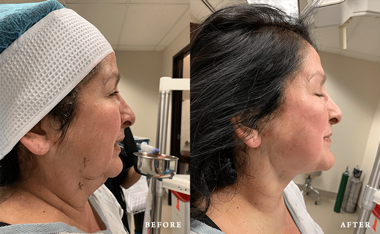 Faces First skin tightening result — Denver, CO