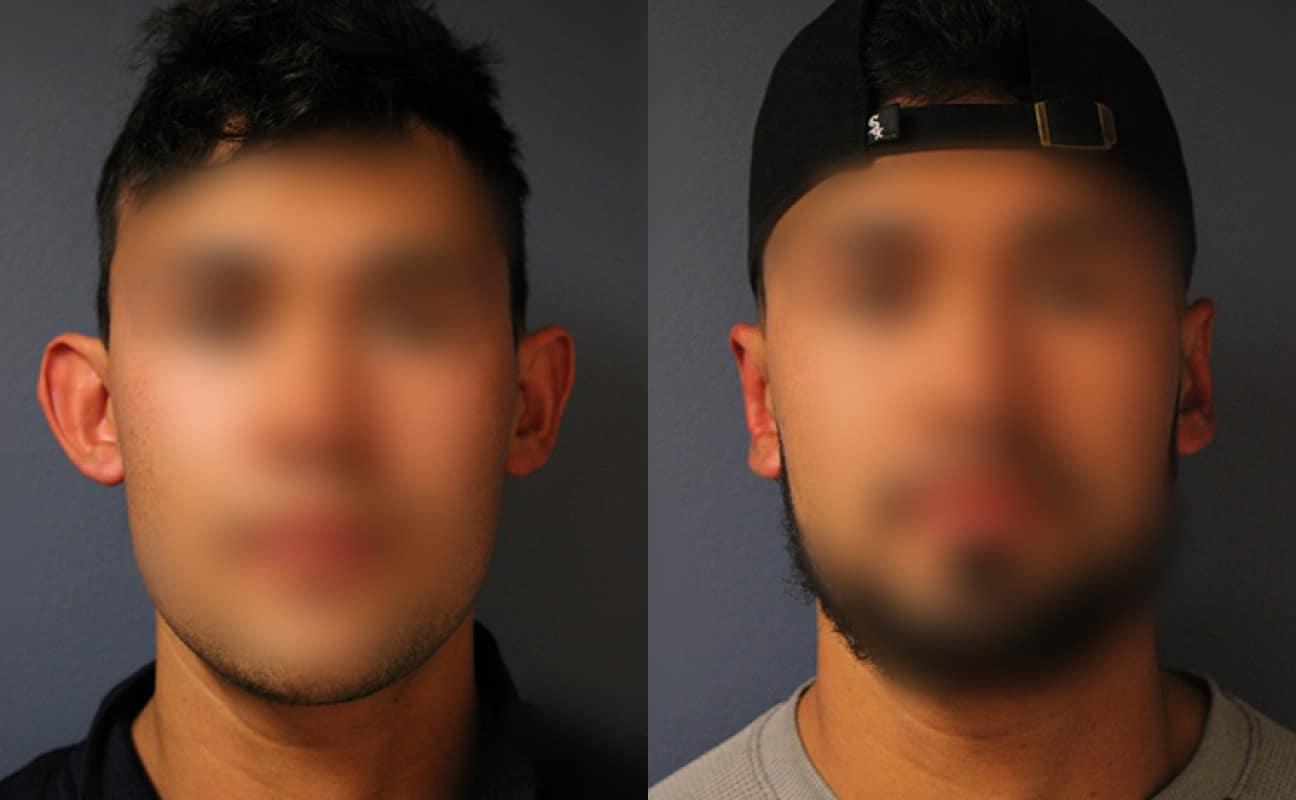 Faces First otoplasty result — Denver, CO