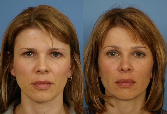 Brow Lift result at Faces First in Denver, CO