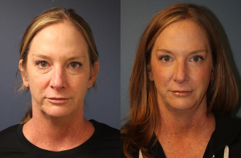Faces First blepharoplasty result — Denver, CO