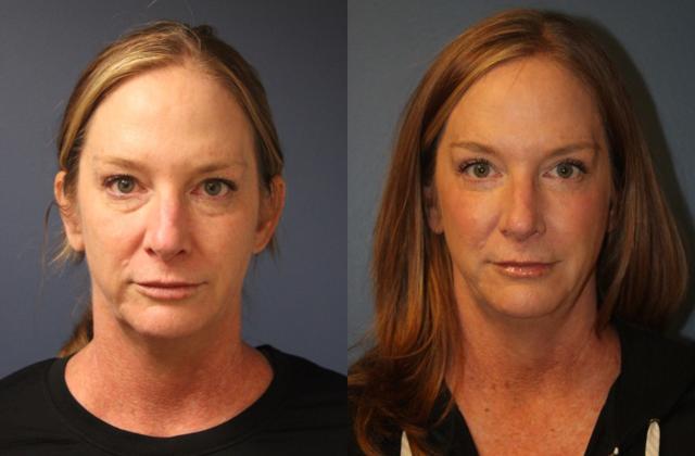 Blepharoplasty result at Faces First in Denver, CO