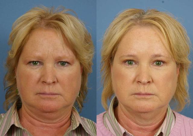 Brow Lift result at Faces First in Denver, CO