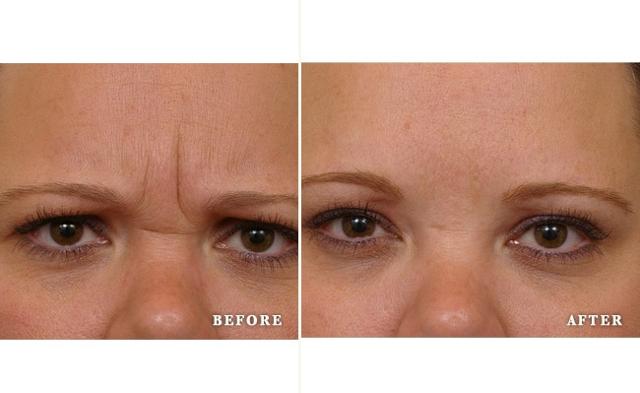 Botox result at Faces First in Denver, CO