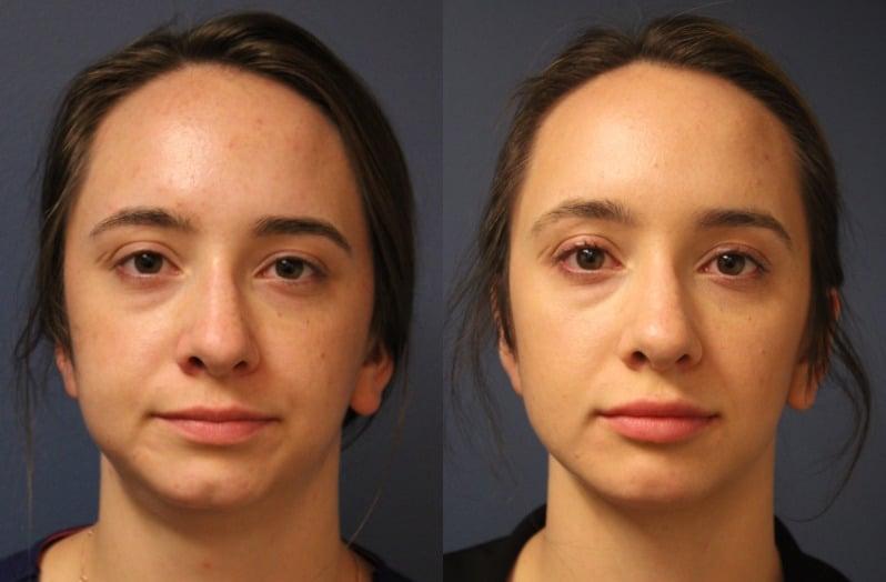 Faces First chin implant result — Denver, CO