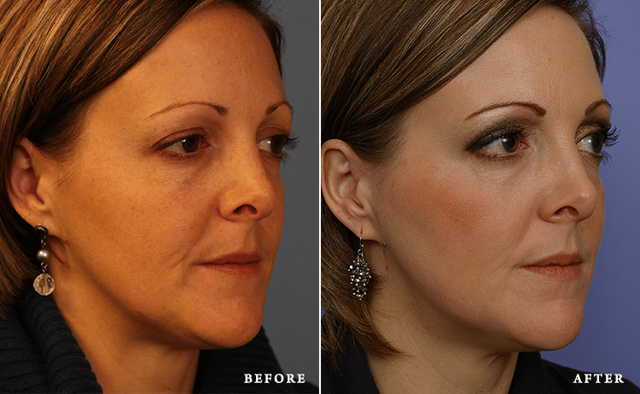 Laser Skin Resurfacing result at Faces First in Denver, CO