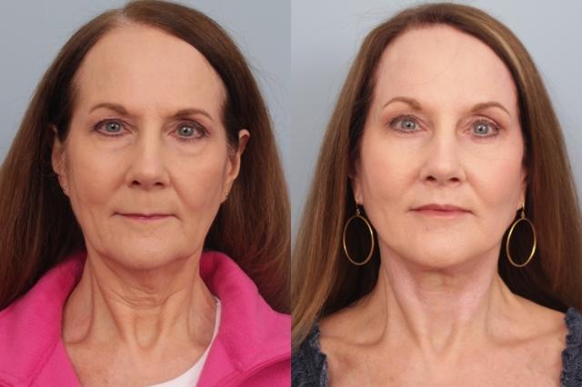 Facelift result at Faces First in Denver, CO