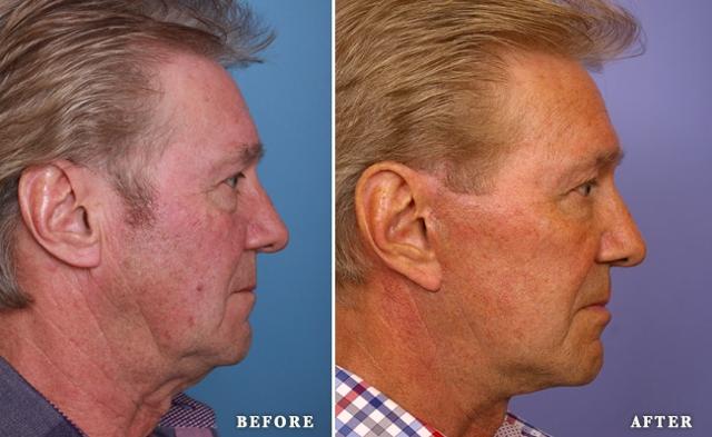 Fat Transfer result at Faces First in Denver, CO
