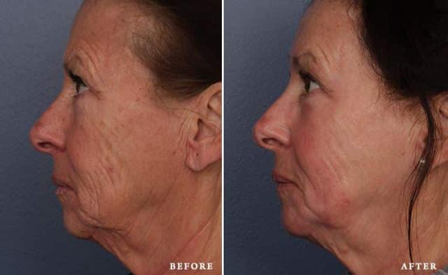 Laser Skin Resurfacing result at Faces First in Denver, CO