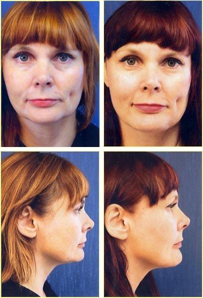 Chin Implant result at Rex Moulton-Barrett, MD Plastic Surgery & MediSpa in Alameda, CA