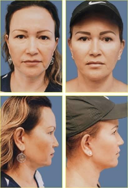 Rex Moulton-Barrett, MD Plastic Surgery & MediSpa facelift result — Alameda, CA