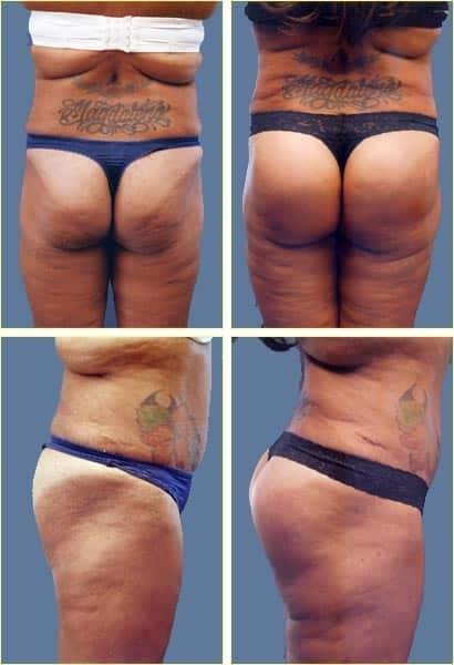 Rex Moulton-Barrett, MD Plastic Surgery & MediSpa bbl result — Alameda, CA