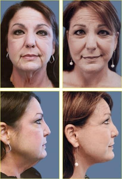 Rex Moulton-Barrett, MD Plastic Surgery & MediSpa facelift result — Alameda, CA