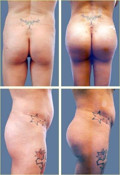 Rex Moulton-Barrett, MD Plastic Surgery & MediSpa bbl result — Alameda, CA