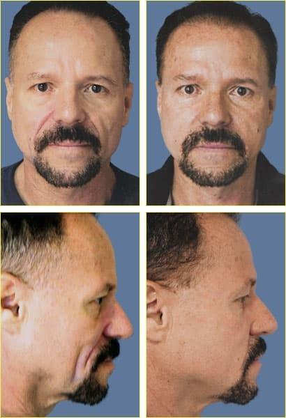 Fat Transfer result at Rex Moulton-Barrett, MD Plastic Surgery & MediSpa in Alameda, CA