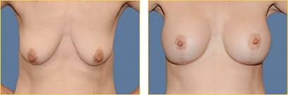Breast Lift result at Rex Moulton-Barrett, MD Plastic Surgery & MediSpa in Alameda, CA