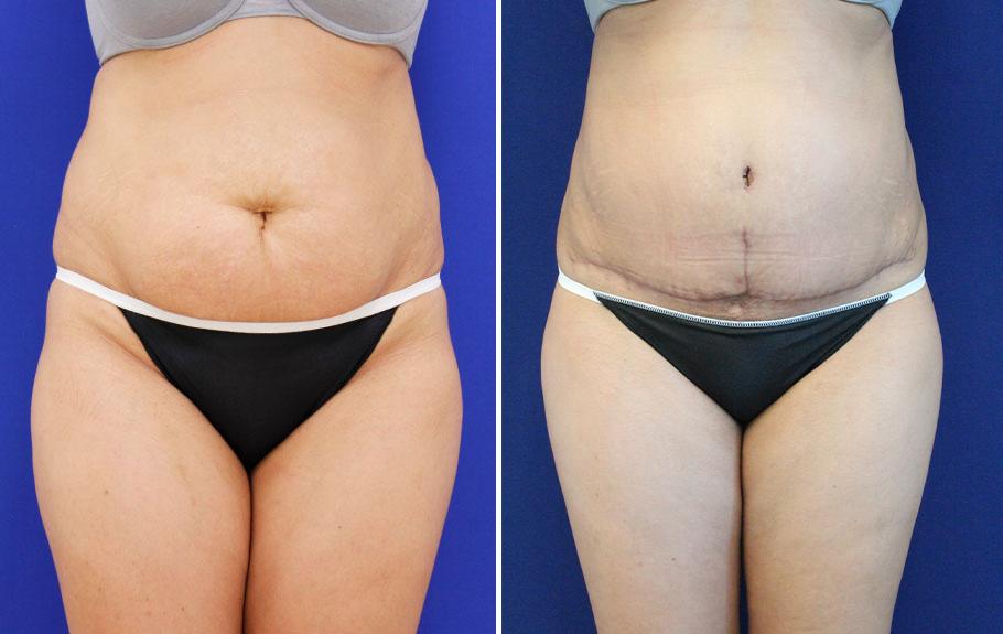 Jason Cooper, MD tummy tuck result — Jupiter, FL