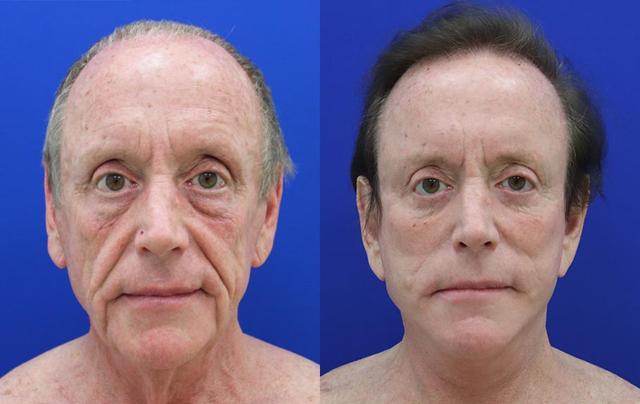 Facelift result at Jason Cooper, MD in Jupiter, FL