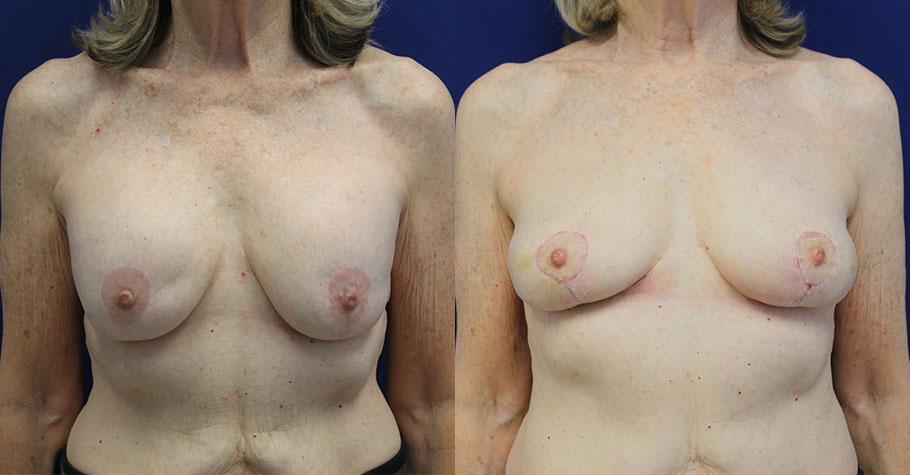Jason Cooper, MD breast implant removal result — Jupiter, FL