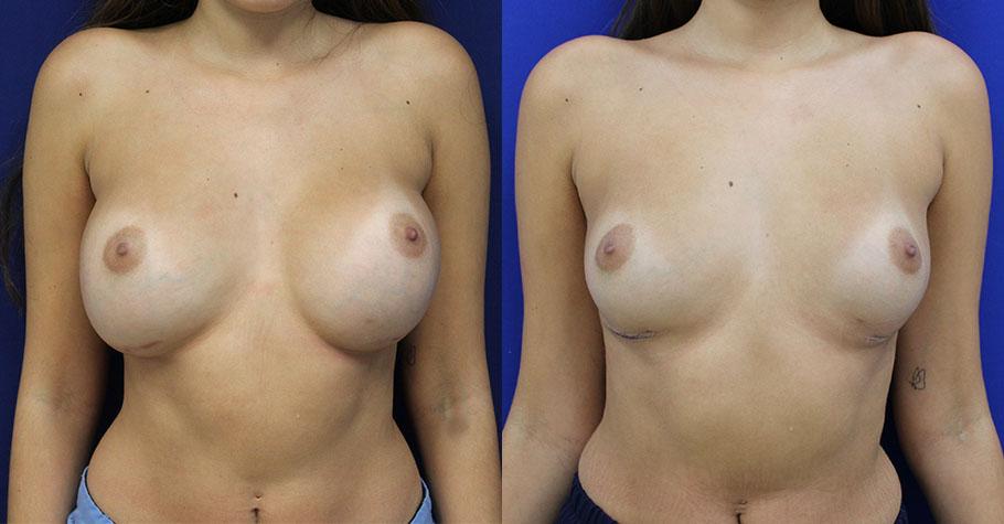 Jason Cooper, MD breast implant removal result — Jupiter, FL