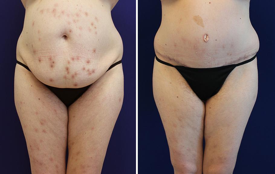 Jason Cooper, MD tummy tuck result — Jupiter, FL