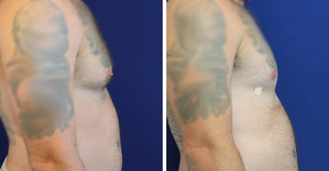 Gynecomastia Surgery result at Jason Cooper, MD in Jupiter, FL