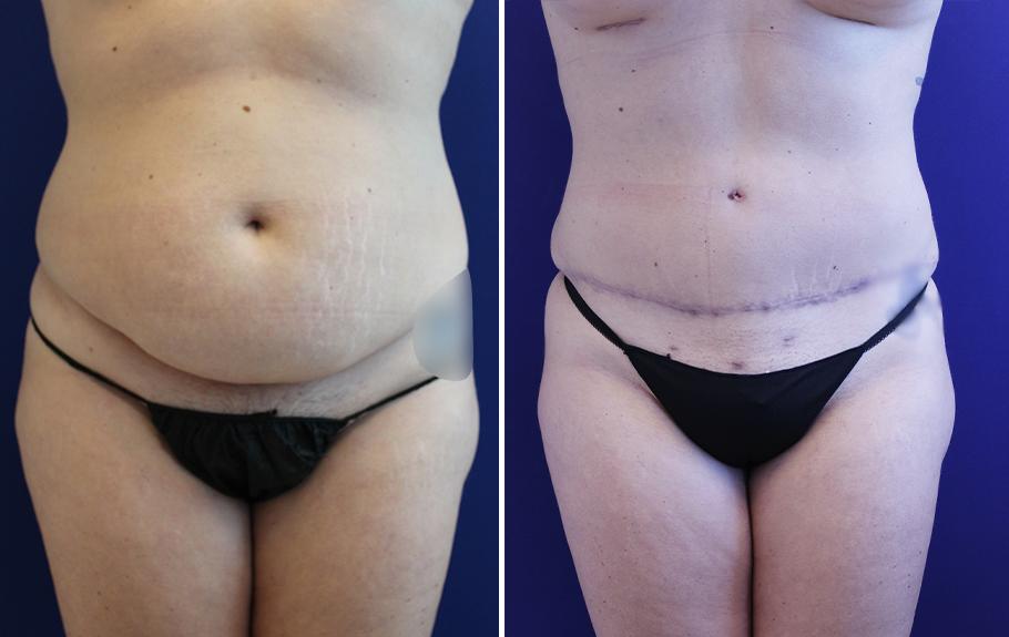 Jason Cooper, MD tummy tuck result — Jupiter, FL