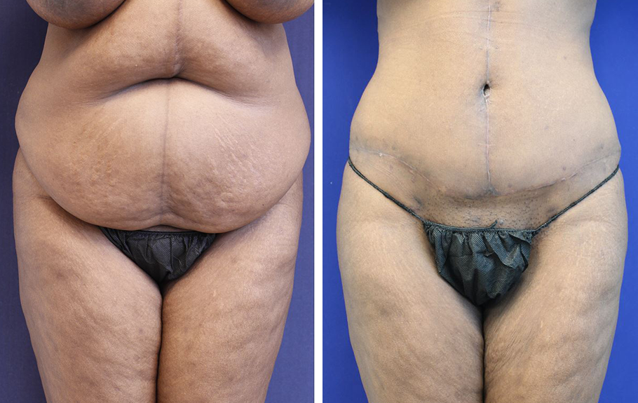 Jason Cooper, MD tummy tuck result — Jupiter, FL